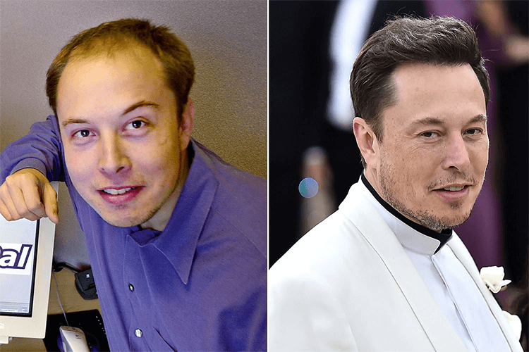 Elon Musk before and after hair transplant