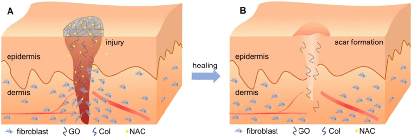 fibrosis in the scalp